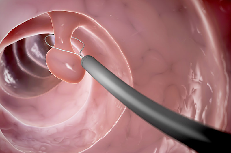 将来的にがん化するポリープがあります